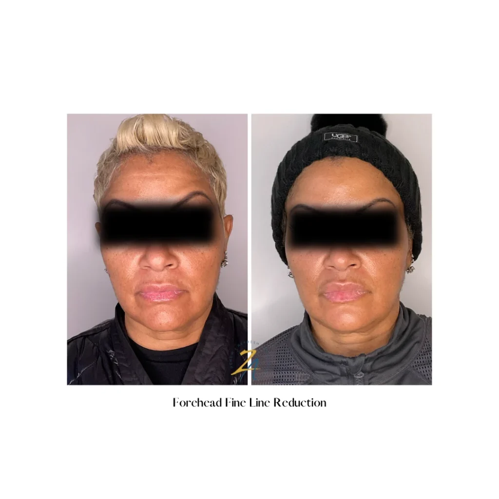 Botox before and after results on two women, eyes covered for privacy