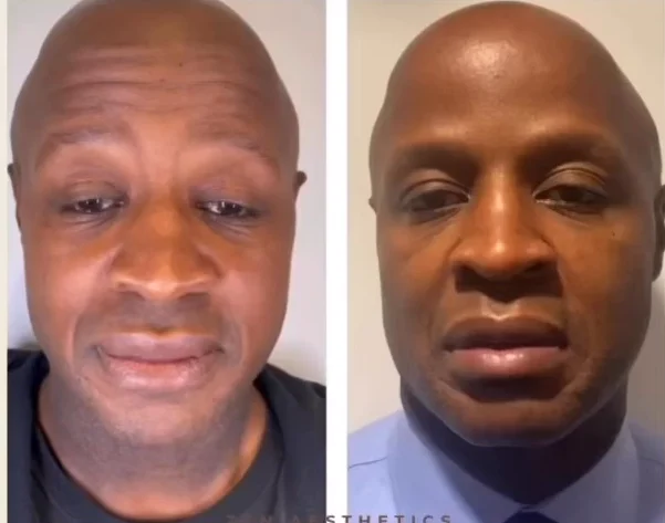 Dysport results, side-by-side close-up portraits of a man's face