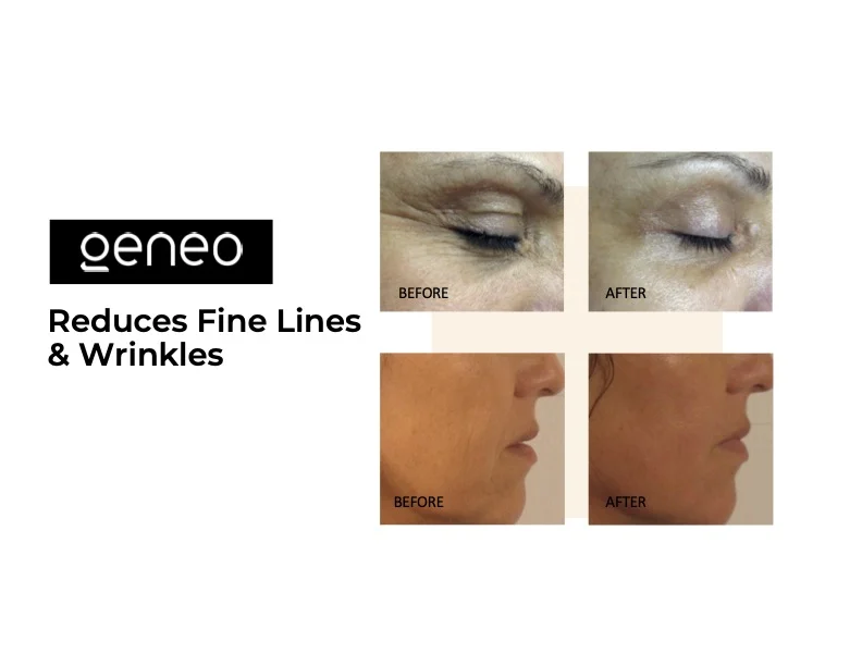 Oxygeneo facial before and after results showing reduced fine lines and wrinkles around the eyes