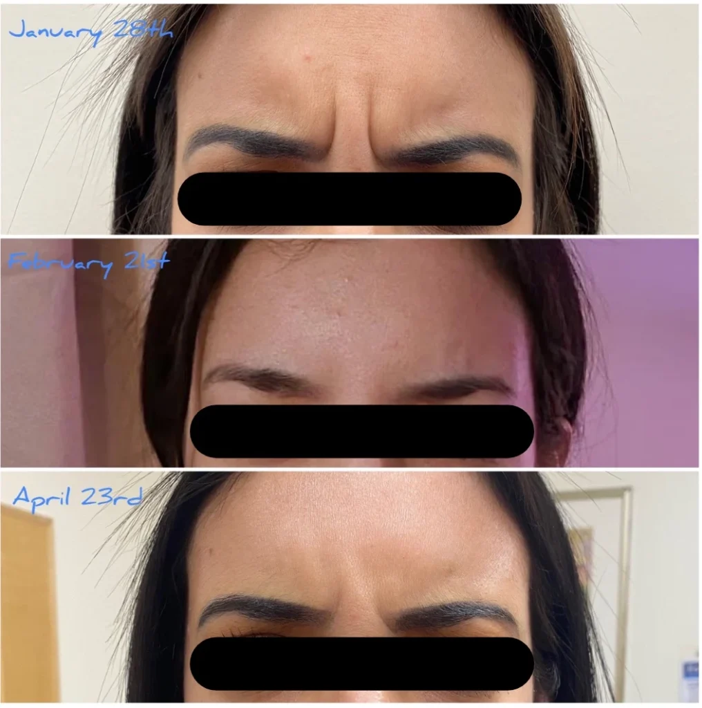 Botox forehead lines before and after results, eyes covered for privacy