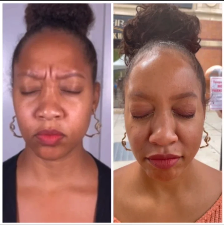 Neurotoxin before and after results showing a smoother forehead and eye area