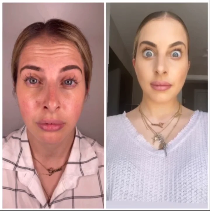 Neurotoxin before and after results on two women, side-by-side portraits