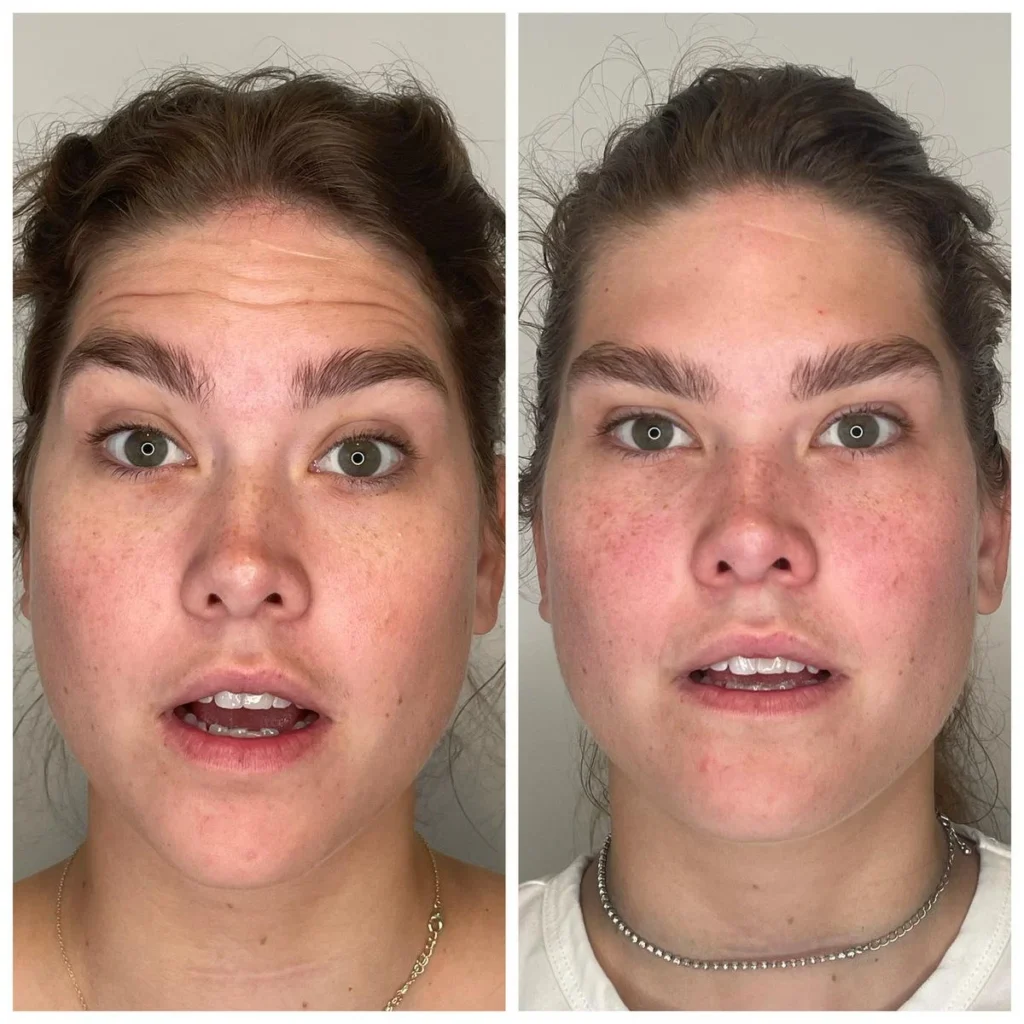 Botox before and after results, side-by-side portraits