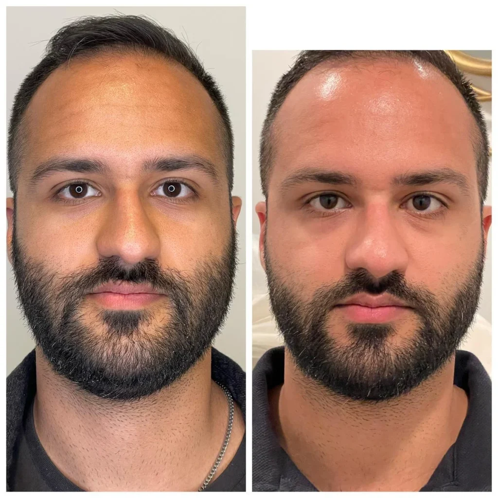 Botox before and after results on a man's face