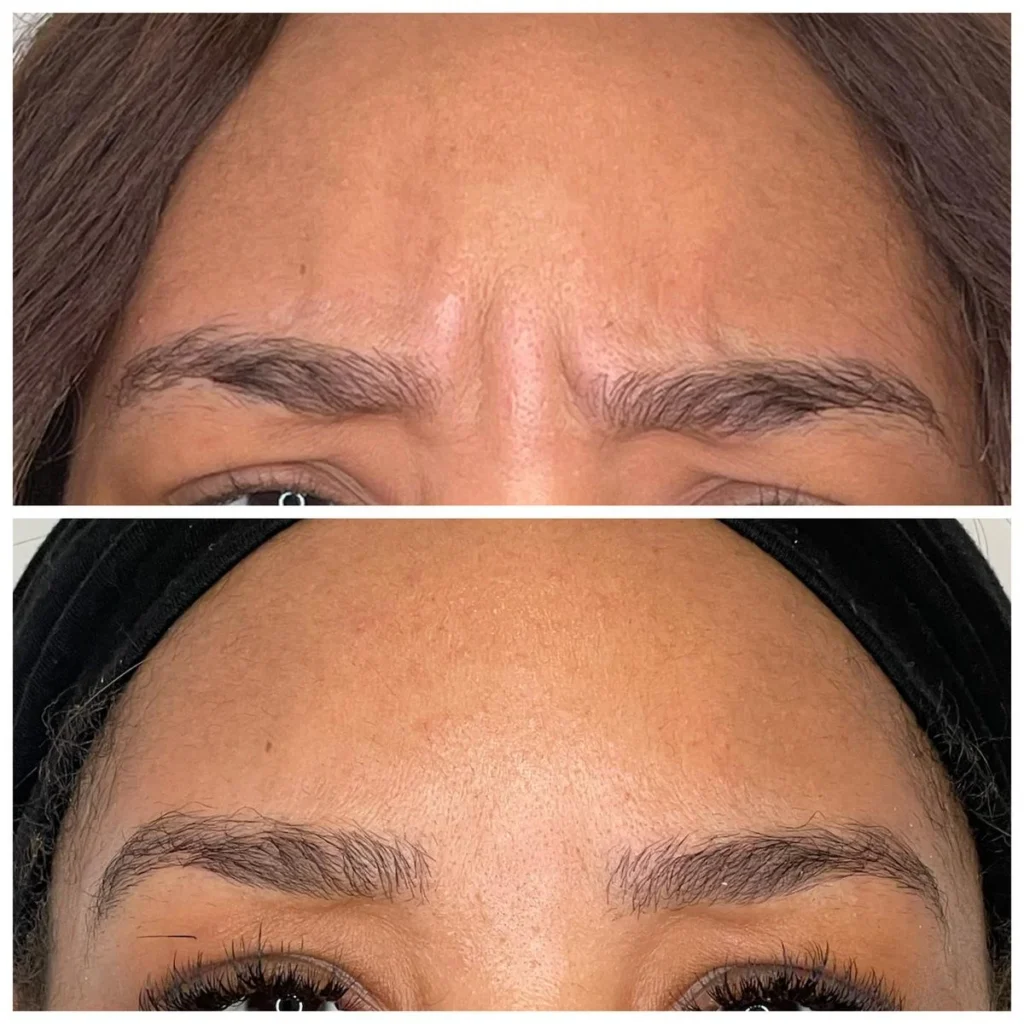 Botox forehead before and after results, close-up