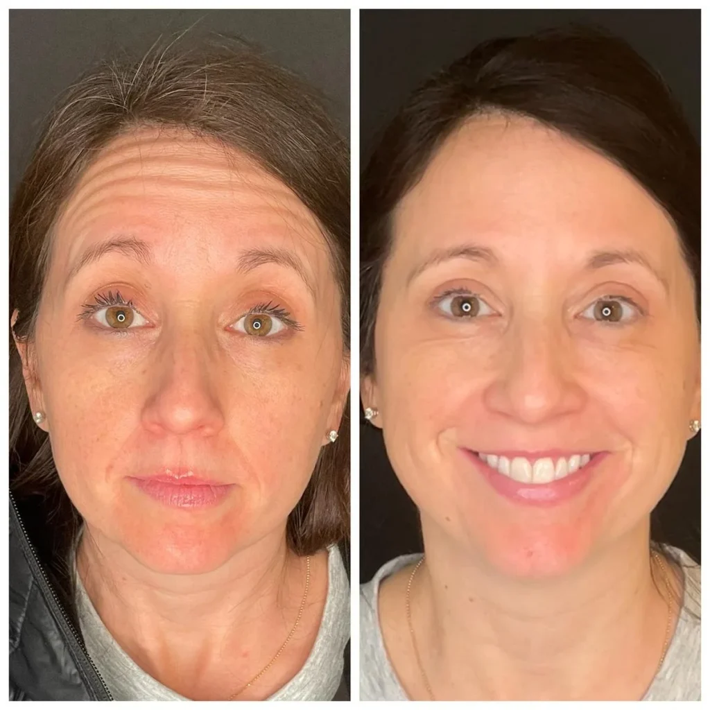 Botox before and after results Morristown NJ