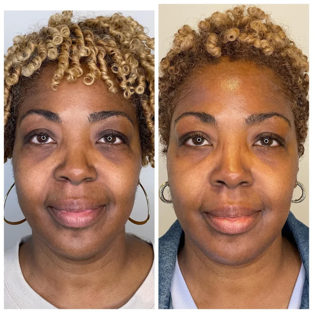 Chemical peel before and after results on skin of color, side-by-side portraits