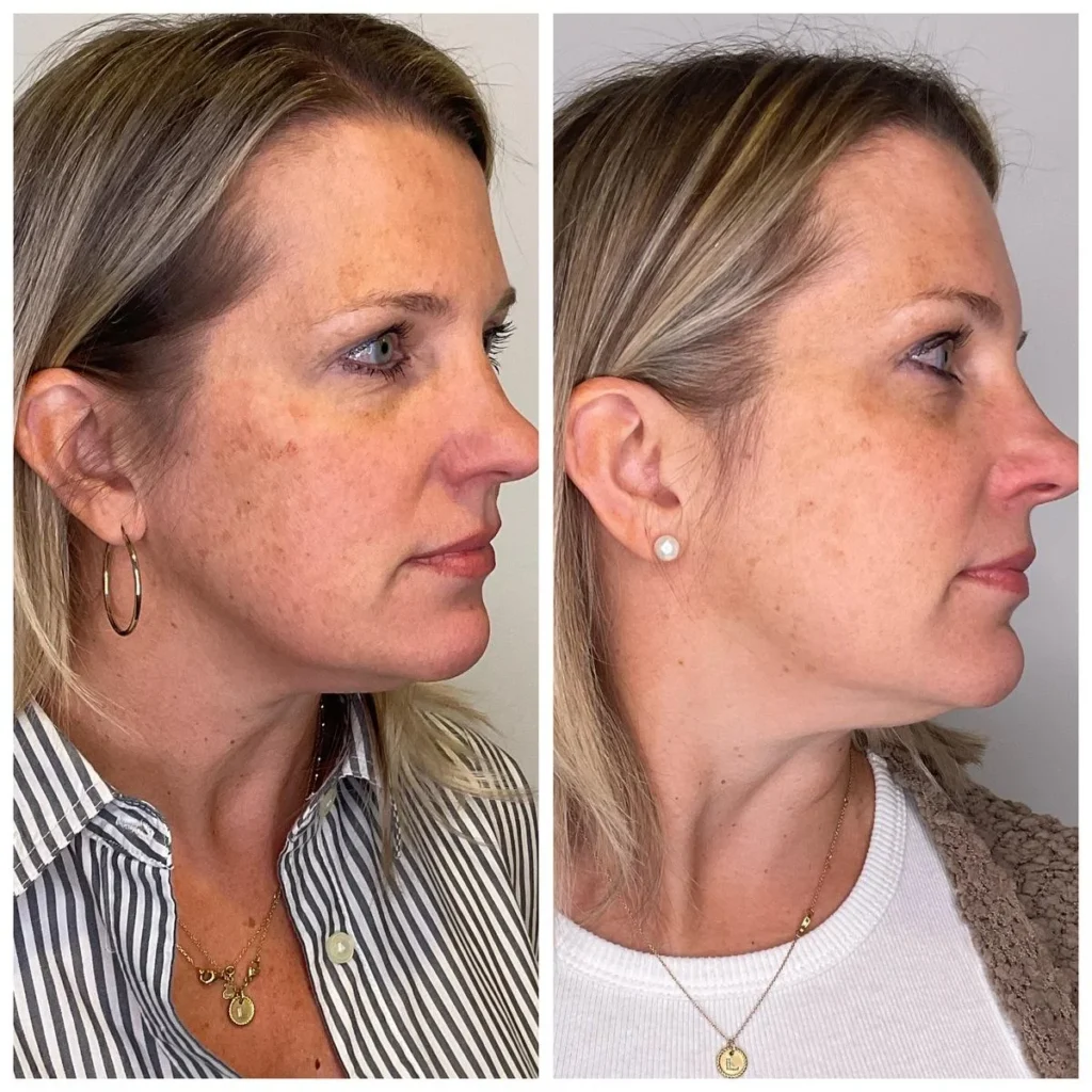 Chemical peel before and after results showing improved skin tone, profile view