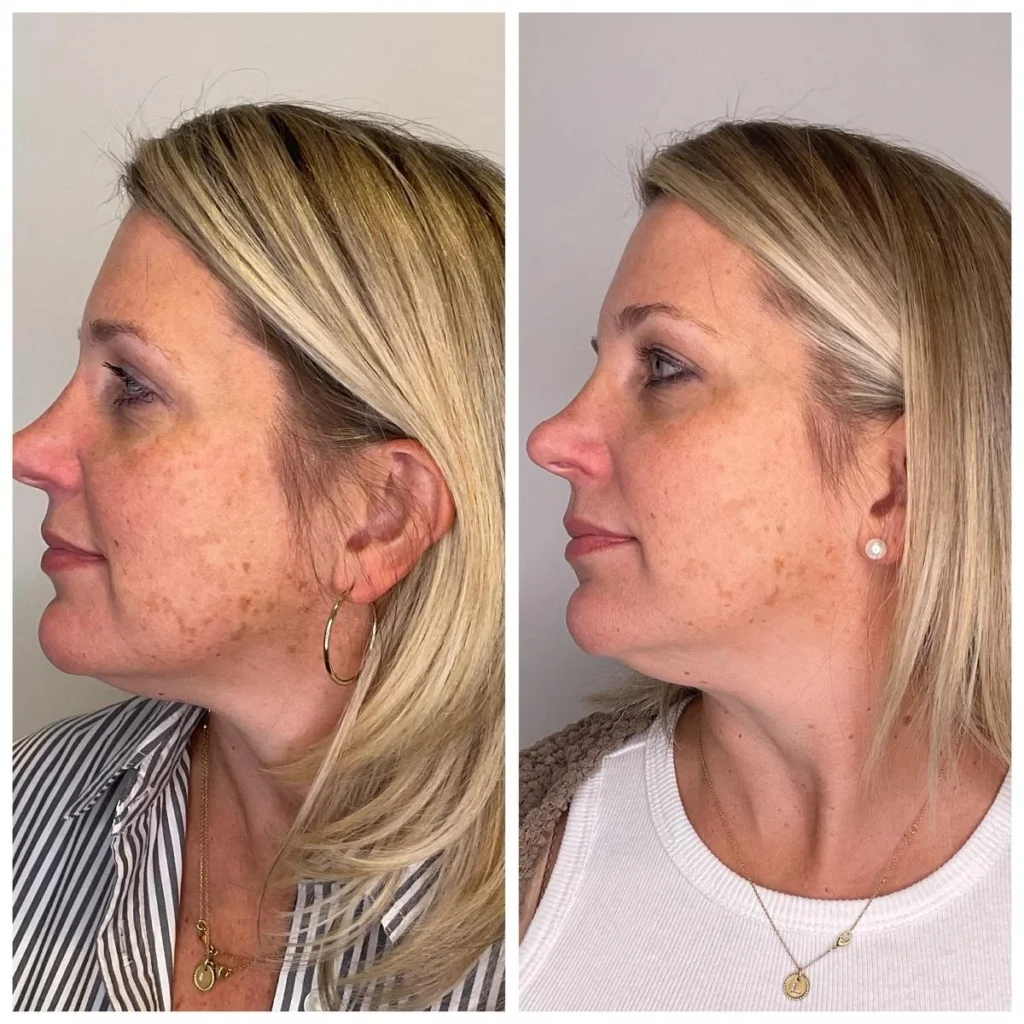 Chemical peel before and after results showing smoother, brighter skin, profile view