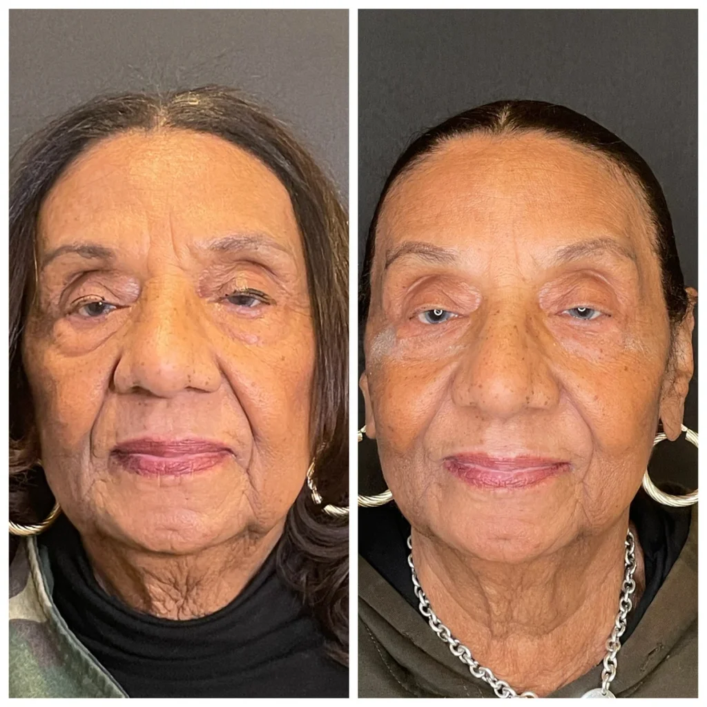 Dermal filler before and after results on an older woman, side-by-side portraits