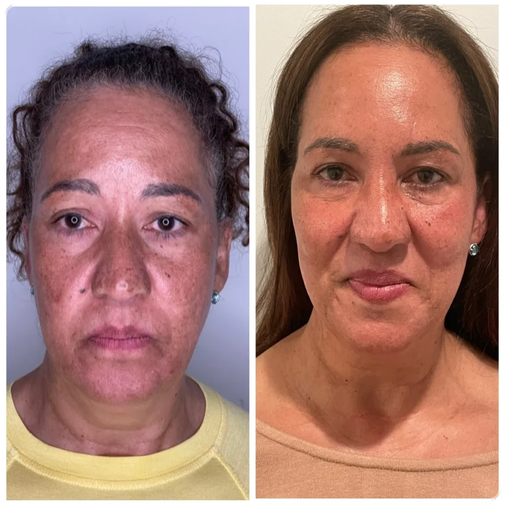 Dermal filler before and after results, side-by-side portraits