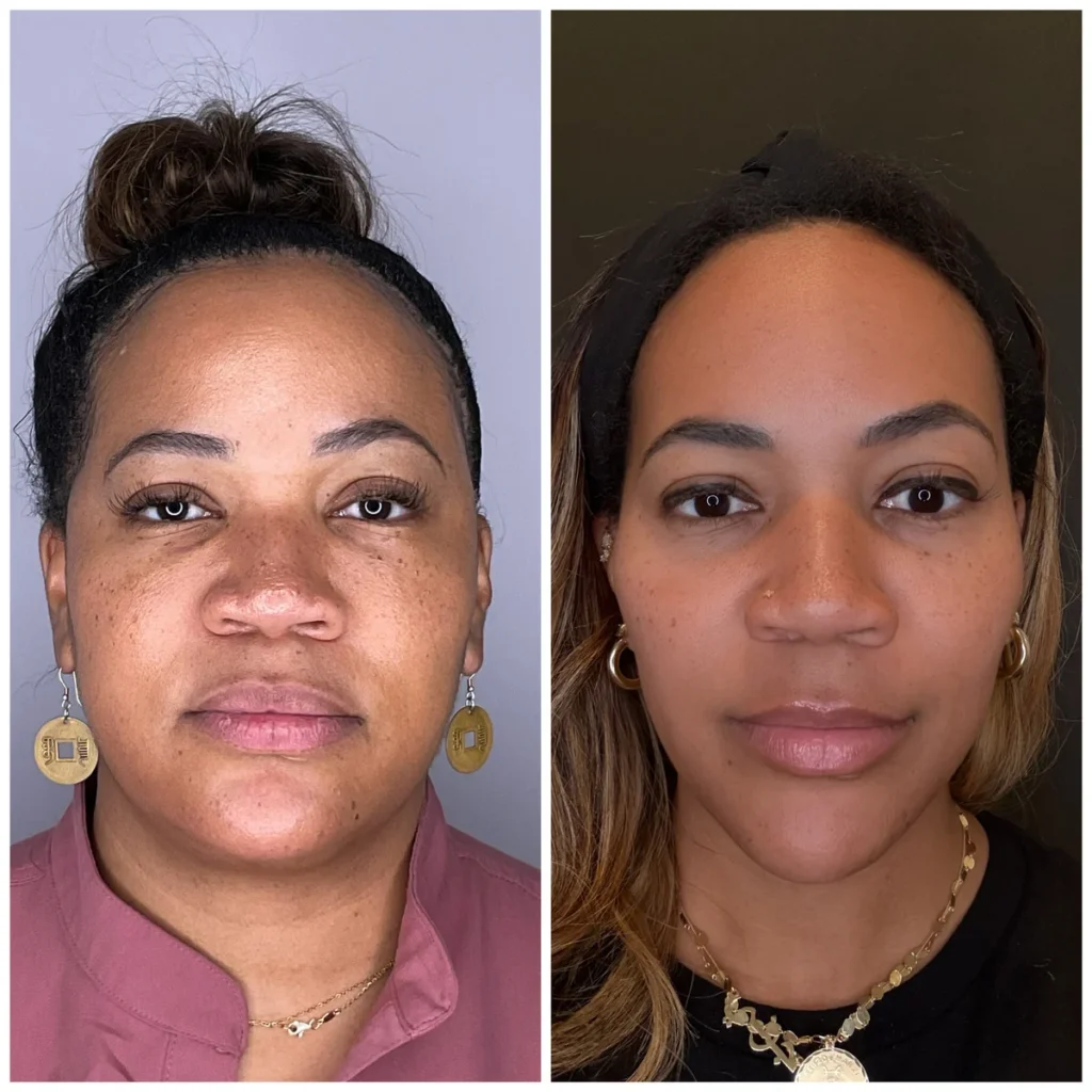 Dermal filler before and after results, side-by-side portraits
