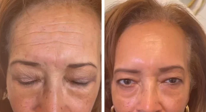 Dysport injectable treatment