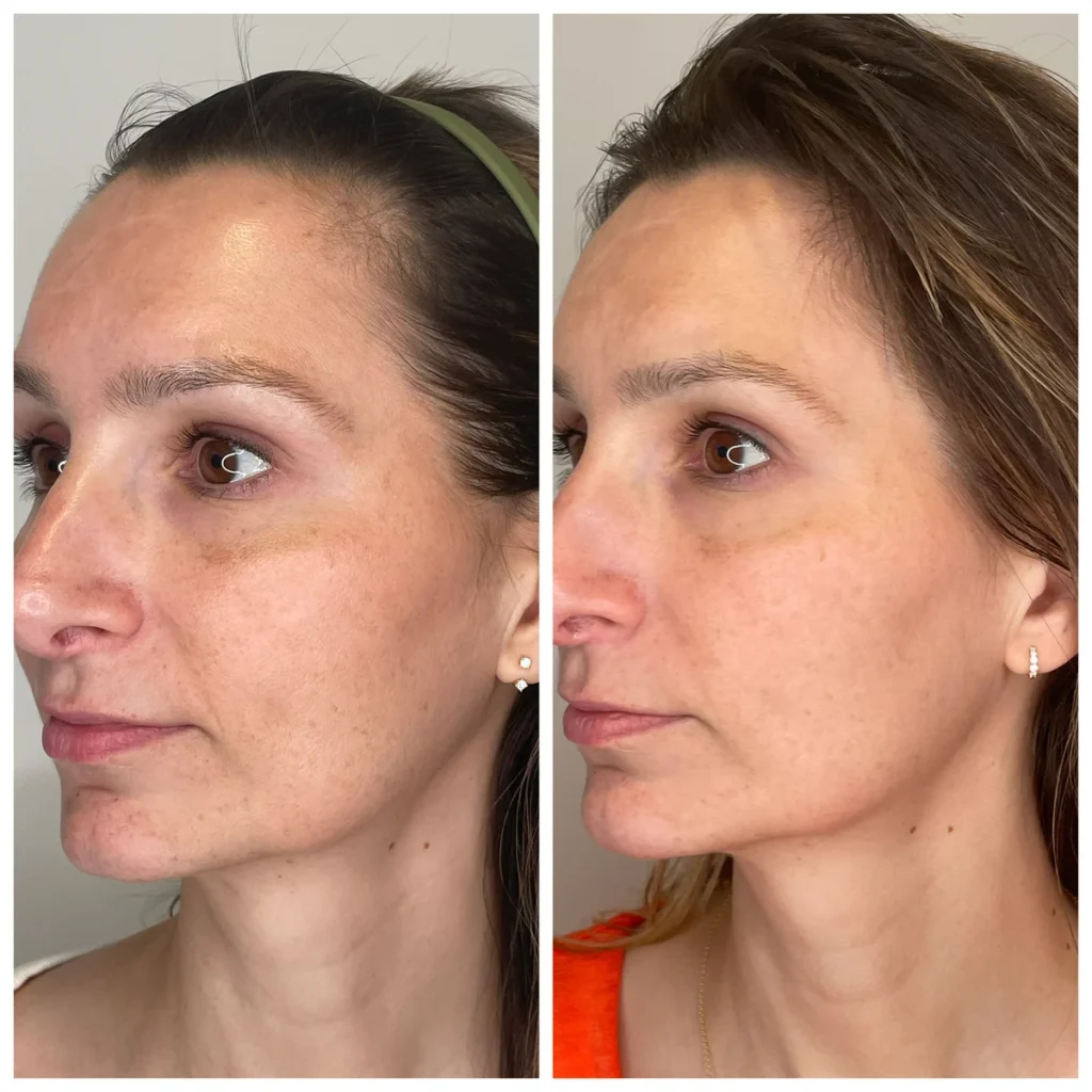Microneedling before and after results on facial skin, side-by-side portraits