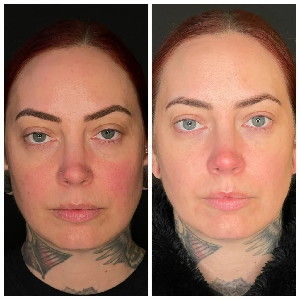Microneedling before and after results showing calmer, more even skin tone