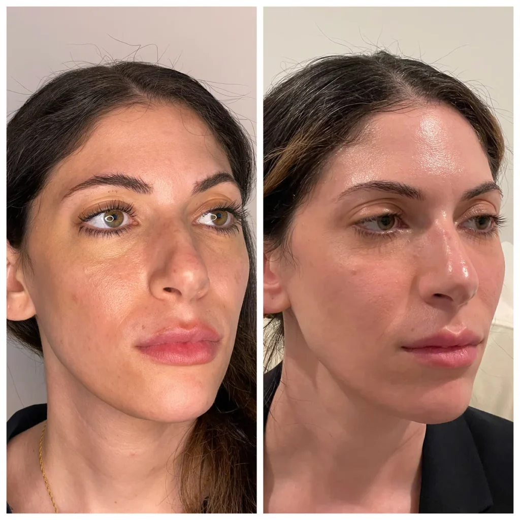 Microneedling before and after results, side-by-side portraits