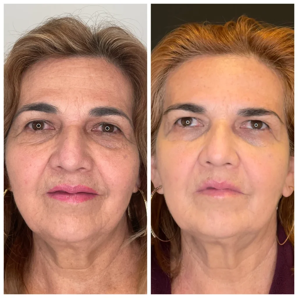 PDO thread lift before and after results, side-by-side portraits