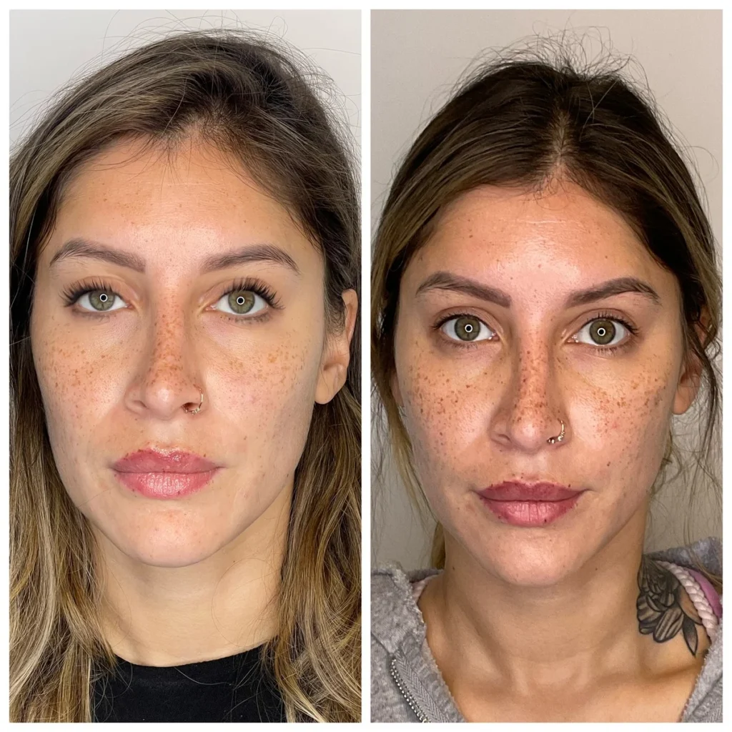 PDO thread lift before and after results, side-by-side portraits