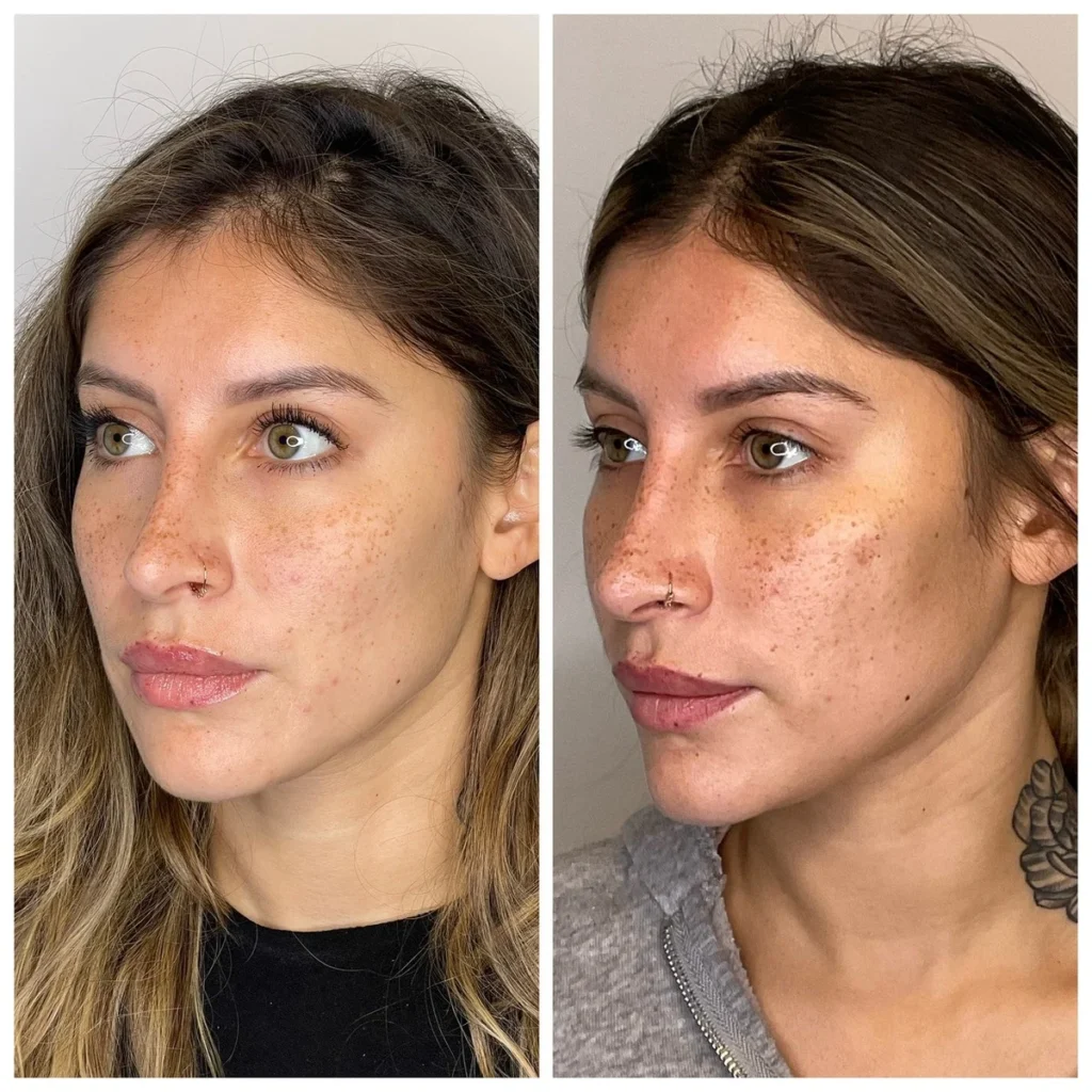 PDO thread lift before and after