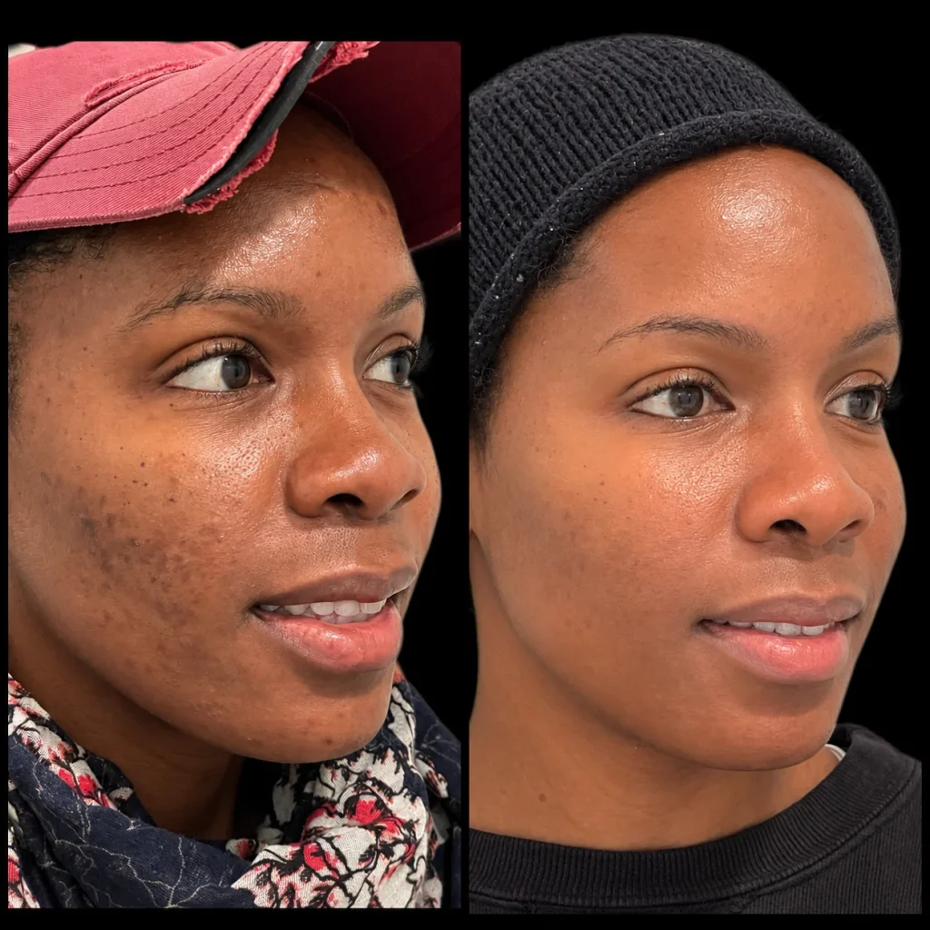 VI chemical peel before and after, result 6, at Zen Aesthetics Spa in Morristown, NJ