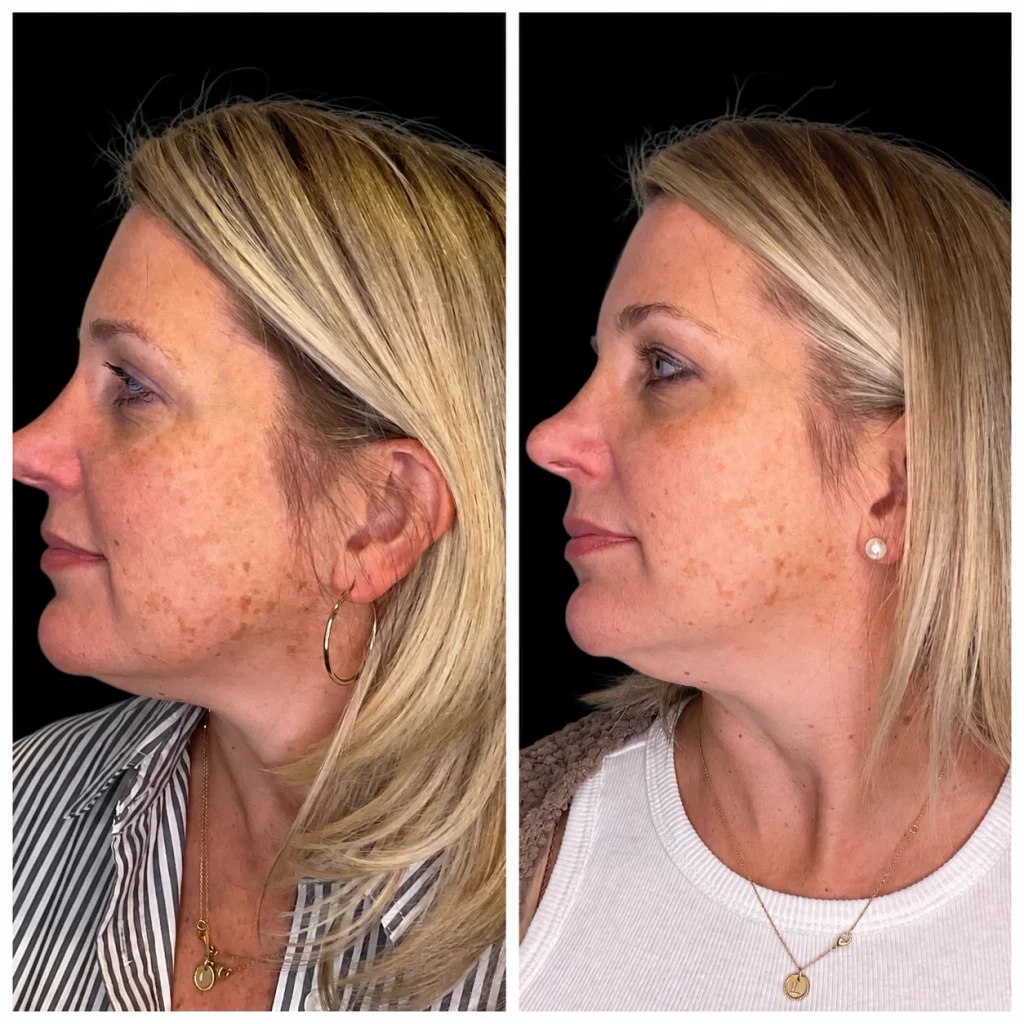 VI chemical peel before and after, result 1, at Zen Aesthetics Spa in Morristown, NJ