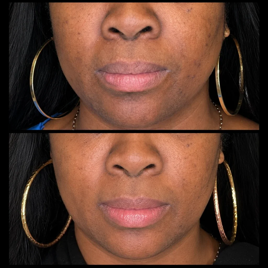 Laser hair removal before and after, result 1, at Zen Aesthetics Spa in Morristown, NJ
