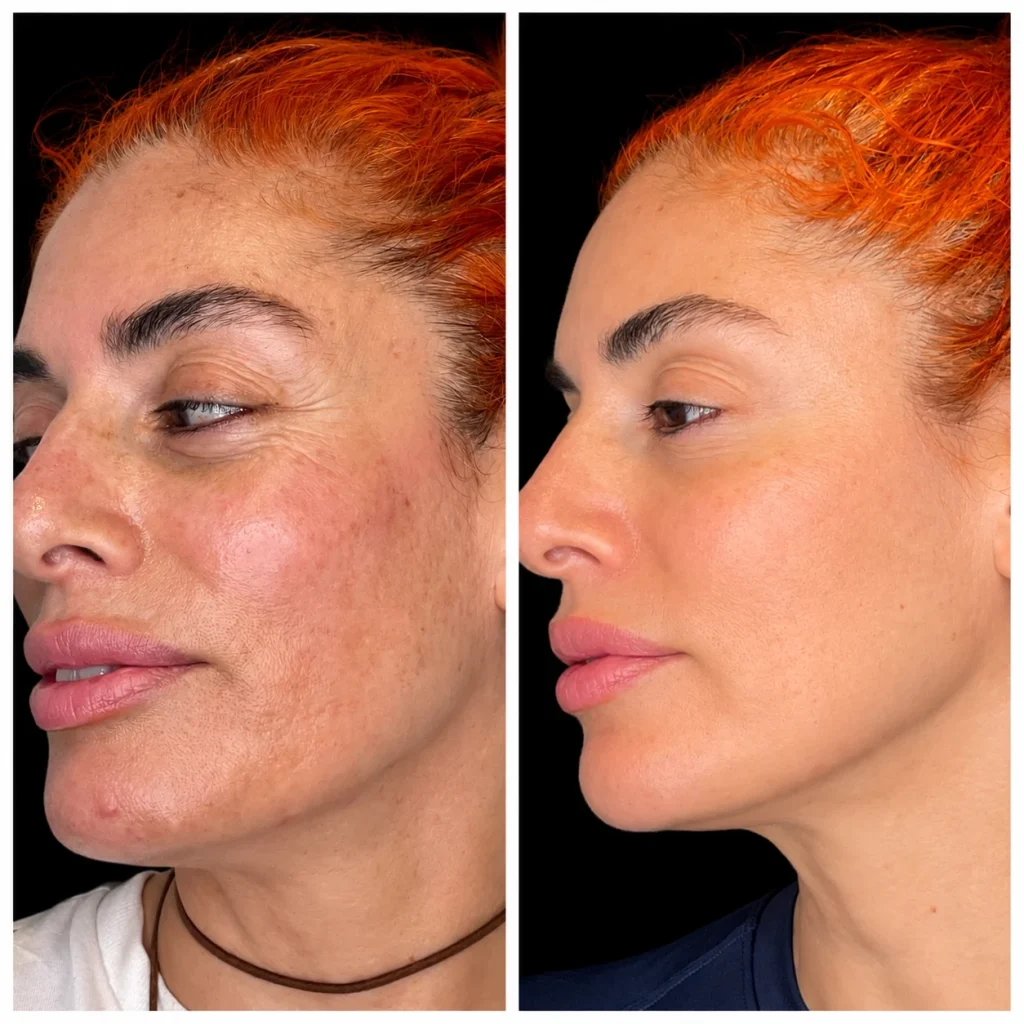 Microneedling before and after, result 1, at Zen Aesthetics Spa in Morristown, NJ