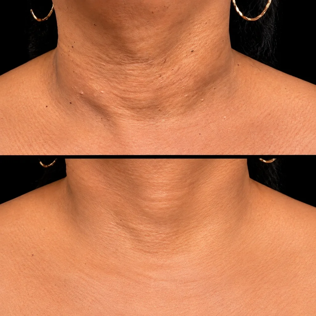 Lamprobe before and after, result 1, at Zen Aesthetics Spa in Morristown, NJ