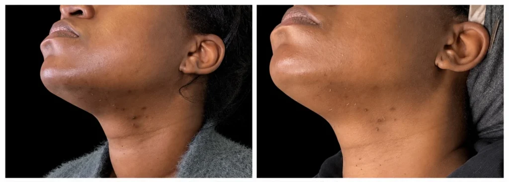 Laser hair removal before and after, result 2, at Zen Aesthetics Spa in Morristown, NJ