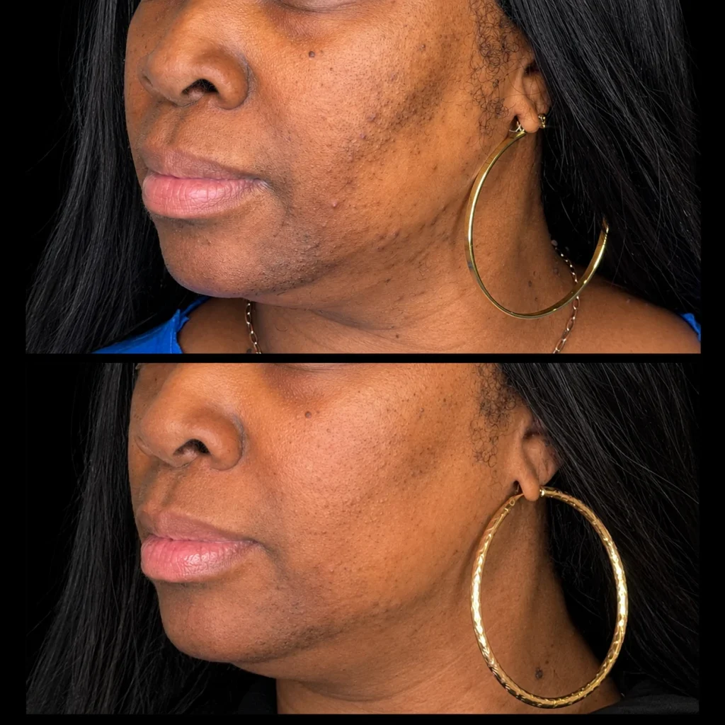 Laser hair removal before and after, result 3, at Zen Aesthetics Spa in Morristown, NJ