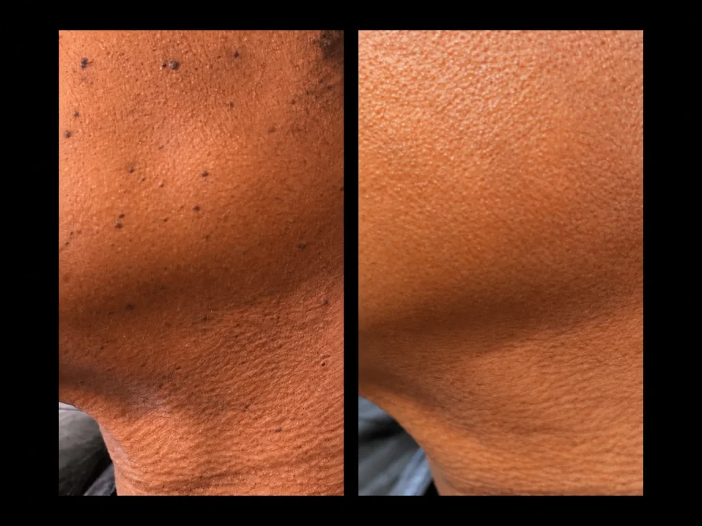 Lamprobe before and after, result 2, at Zen Aesthetics Spa in Morristown, NJ