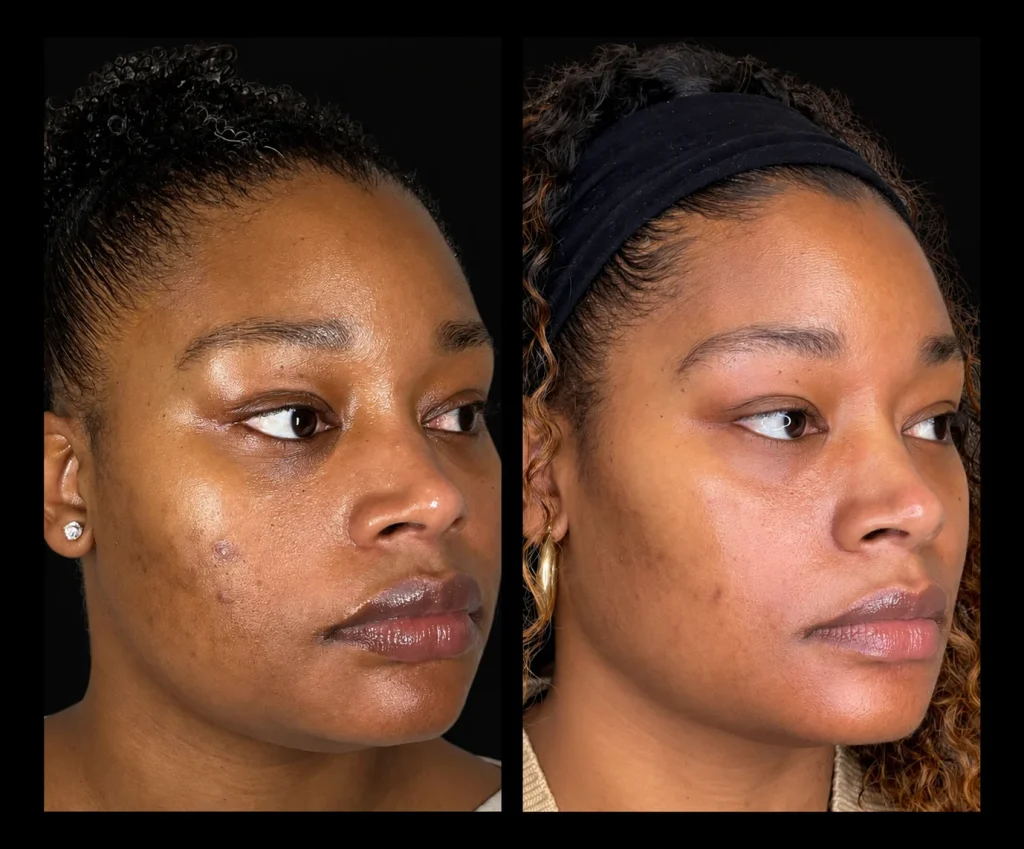 VI chemical peel before and after, result 2, at Zen Aesthetics Spa in Morristown, NJ