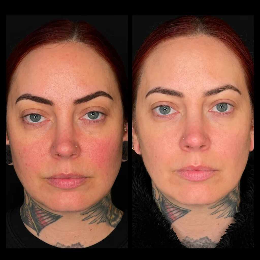 Microneedling before and after, result 9, at Zen Aesthetics Spa in Morristown, NJ