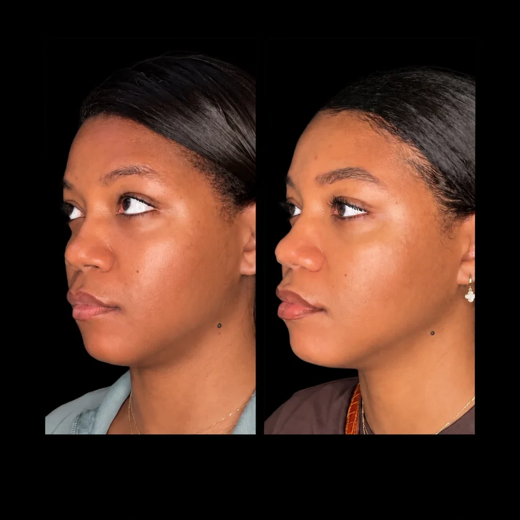 Microneedling before and after, result 10, at Zen Aesthetics Spa in Morristown, NJ