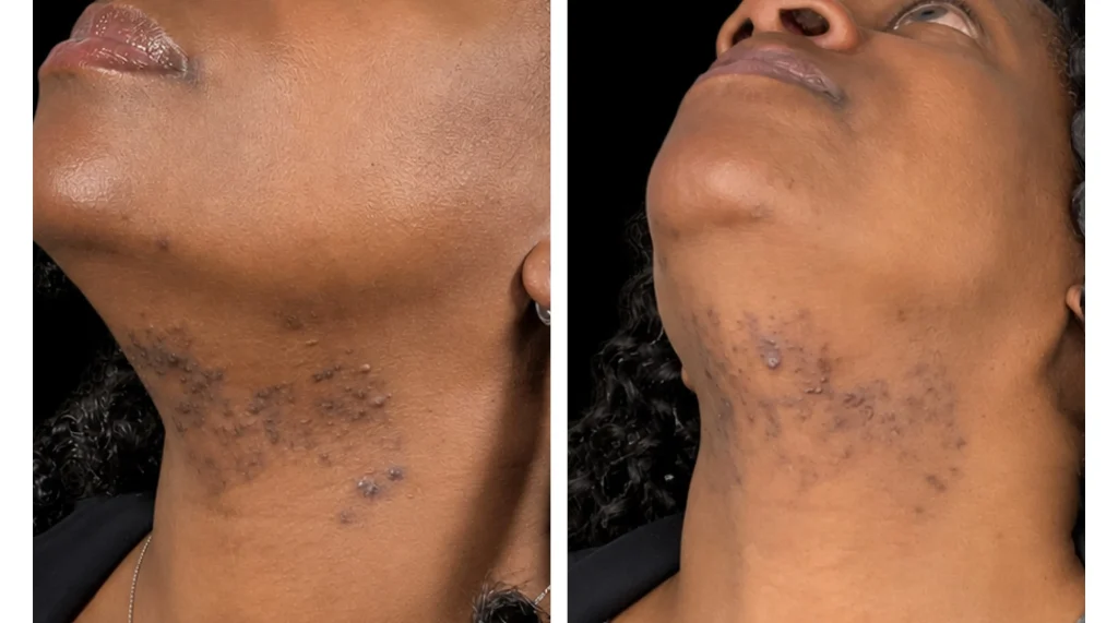 Laser hair removal before and after, result 5, at Zen Aesthetics Spa in Morristown, NJ