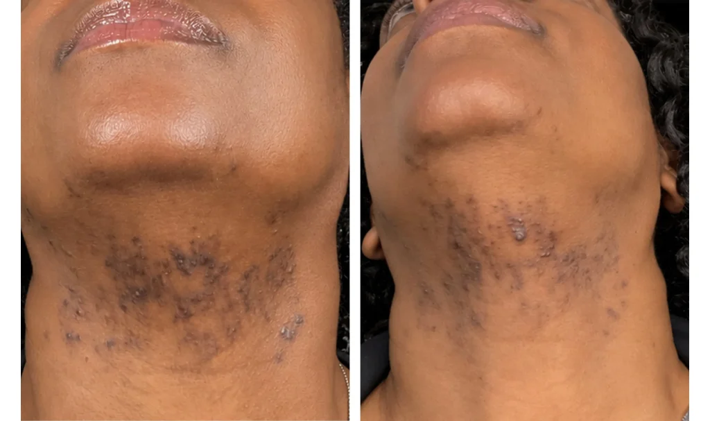 Laser hair removal before and after, result 6, at Zen Aesthetics Spa in Morristown, NJ