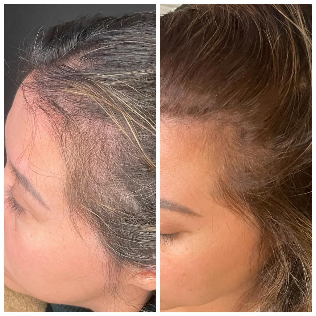 PRFM hair restoration before and after, result 10, at Zen Aesthetics Spa in Morristown, NJ