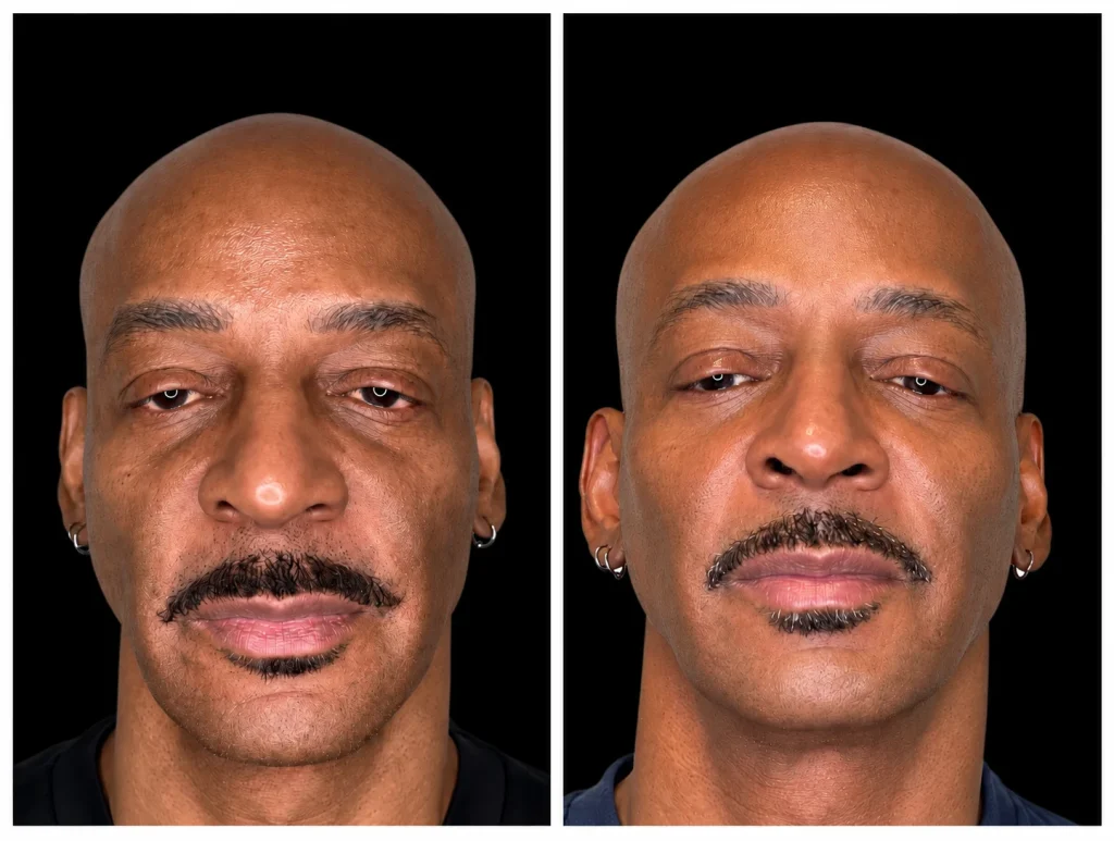 Sculptra before and after for facial volume and collagen, result 2, at Zen Aesthetics Spa in Morristown, NJ